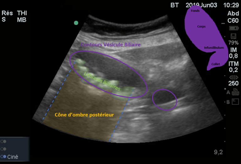 Vésicule Biliaire – ADMSU