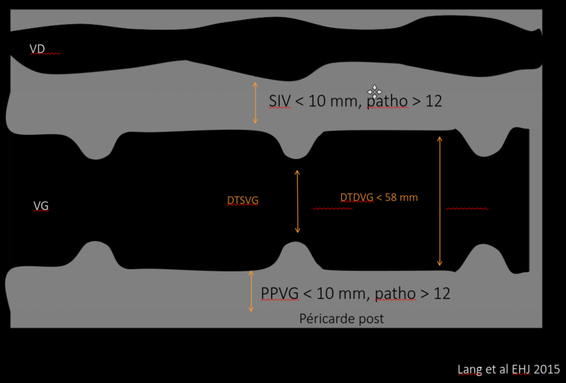 Fichier:Echo paroi VG.png