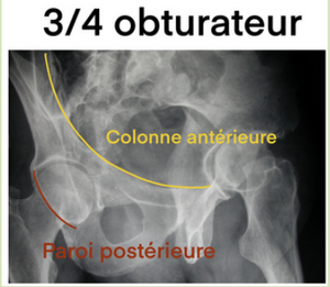 Rx obturateur.png