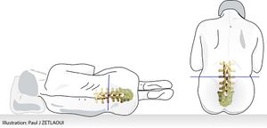 Ponction lombaire illustration du patient.jpg