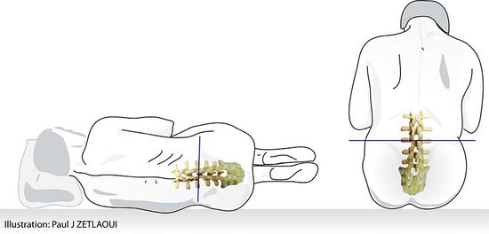 Ponction lombaire illustration du patient.jpg