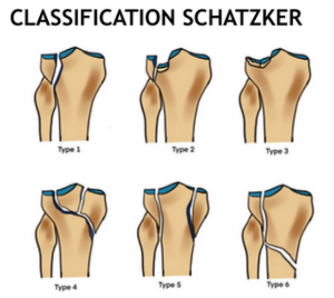 Tibia schatzker.png
