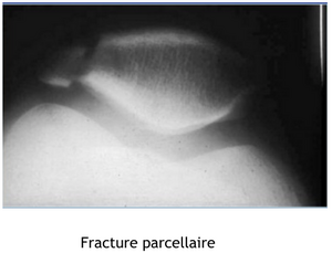 Rotule fracture03.png
