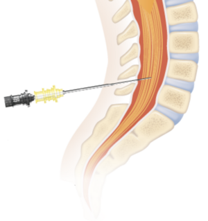 Ponction lombaire aiguille.png