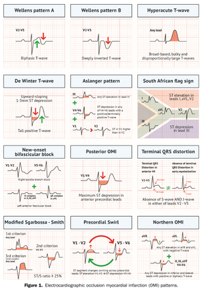 Ecg pettern2025-02.png