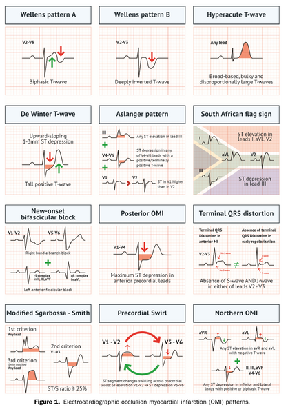 Fichier:Ecg pettern2025-02.png