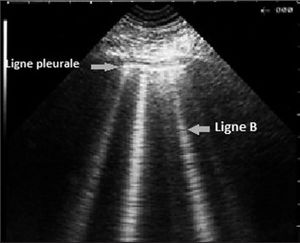 Echographie ligneB.jpg