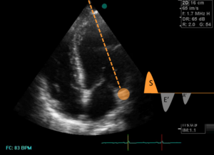 OndeS mitral doppler.png