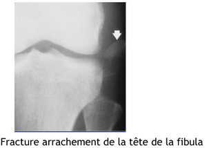Genou fibula.png