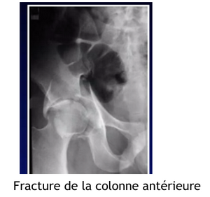 Fracture colonne ant.png