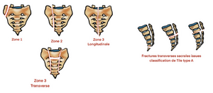 Sacrum fracture.png