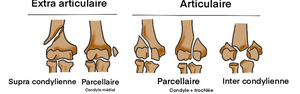Palette humerale fracture schema.png