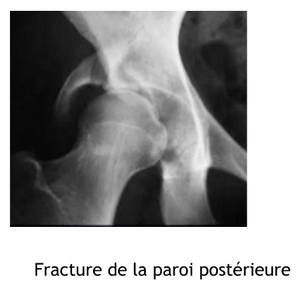 Fracture paroi post.png